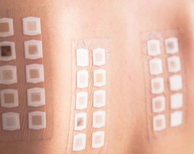 Patch testing